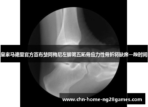 皇家马德里官方宣布楚阿梅尼左脚第五跖骨应力性骨折将缺席一段时间